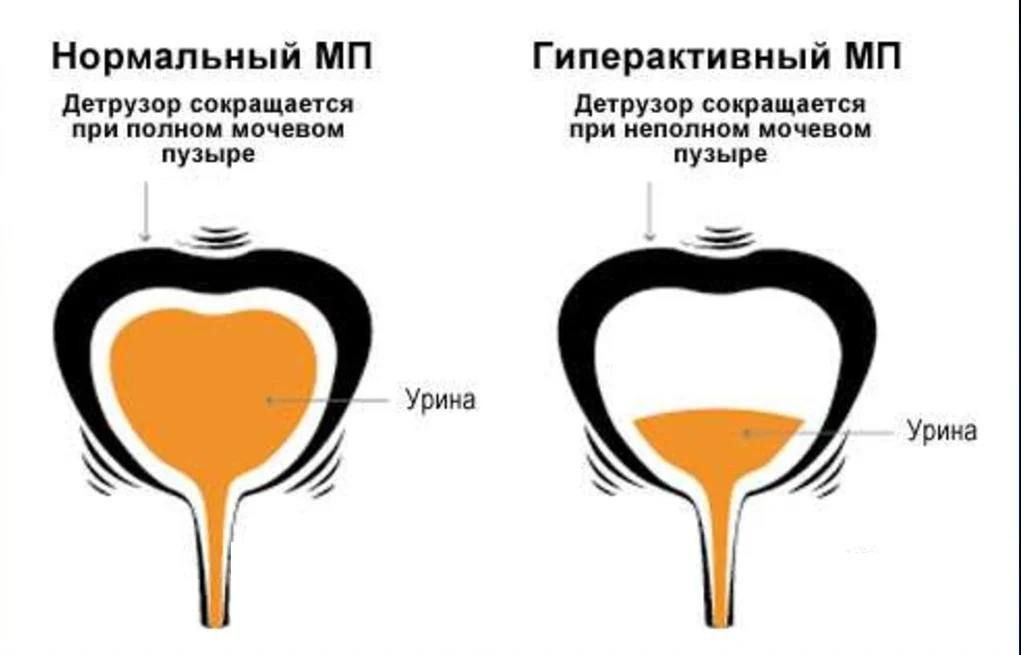 Мочевой пузырь пустой но хочется в туалет