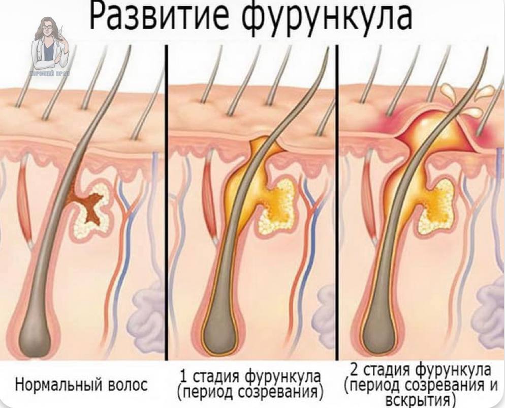 Кожа приросла. Суппуративный гидраденит. Абсцедирующий фурункул.